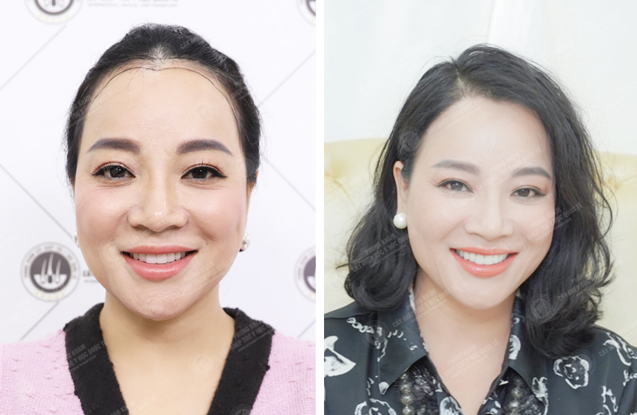  Lưu Bích Nguyệt - Cấy tóc tự thân 1