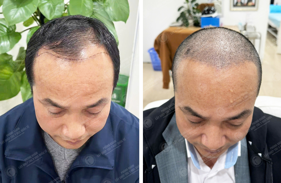  Trần Trung Anh - Cấy tóc tự thân 1