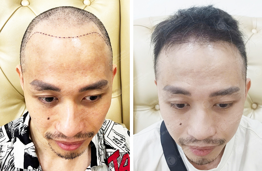  Lý Văn Thế - Cấy tóc đường chữ M 1