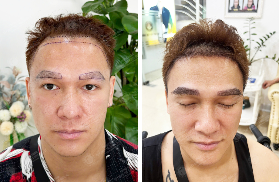  Đoàn Văn Sơn - Cấy tóc tự thân 1