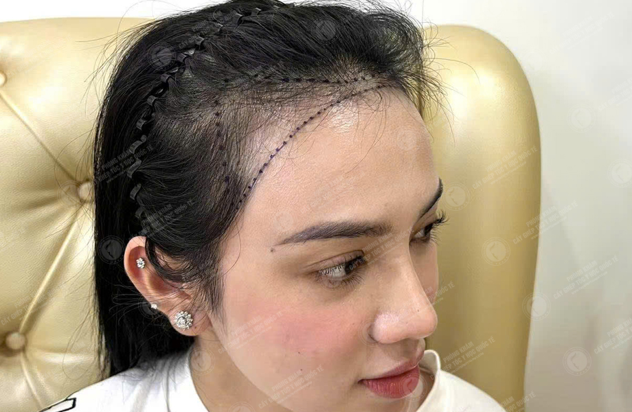 Lê Hồng Nhung - Cấy tóc đường chữ M 3
