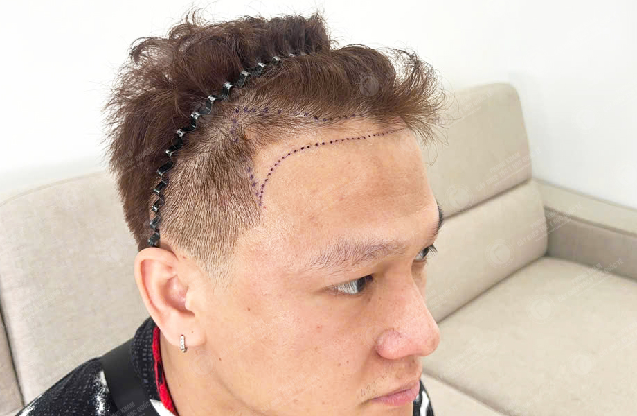 Đoàn Văn Sơn - Cấy lông mày 3