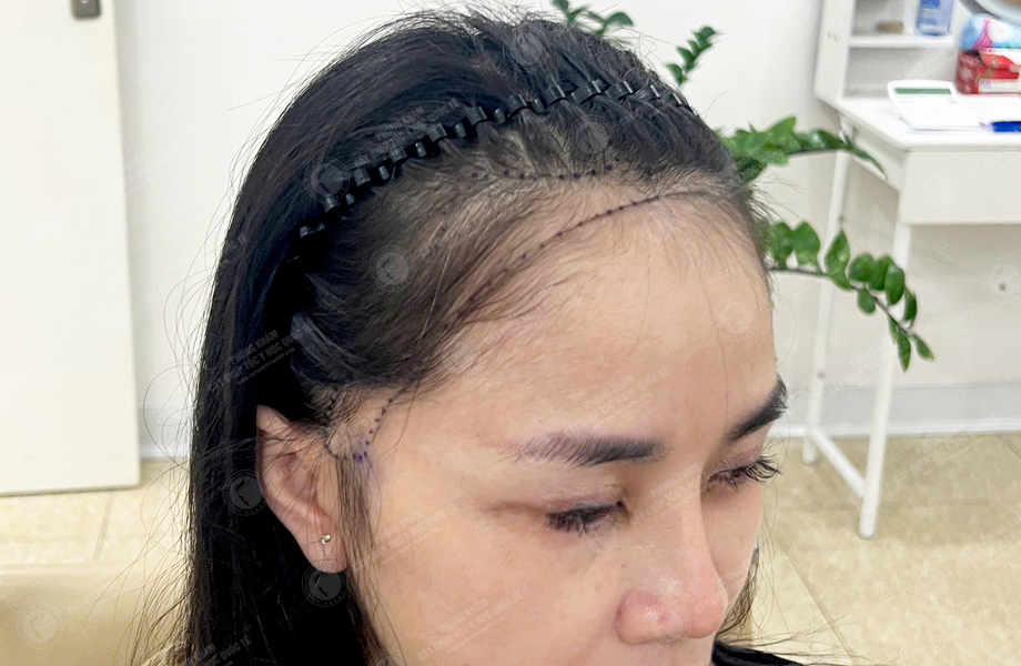 Lê Thị Hạnh - Cấy tóc đường chữ M 3