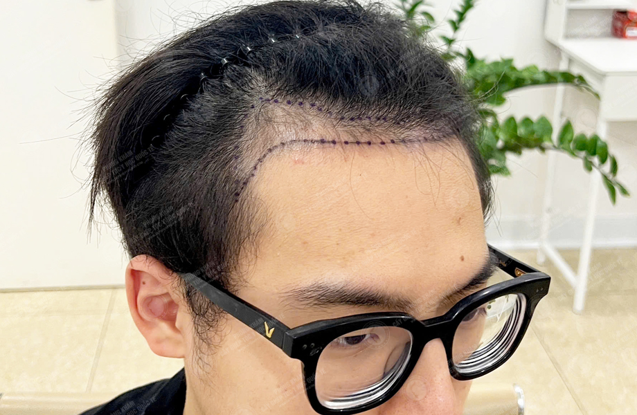 Hoàng Văn Tài - Cấy tóc đường chữ M 3