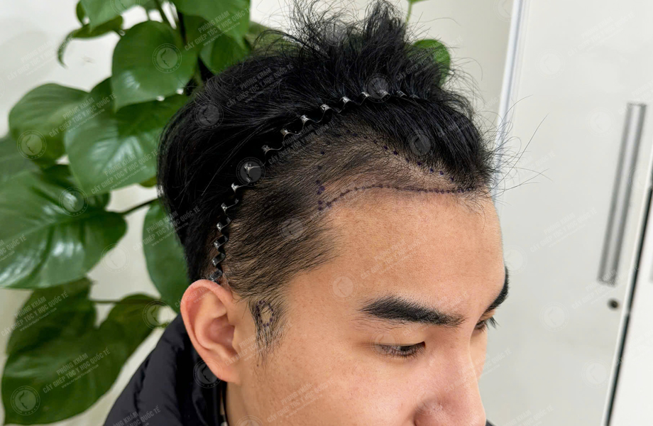 Nguyễn Đức Hùng - Cấy tóc đường chữ M 3