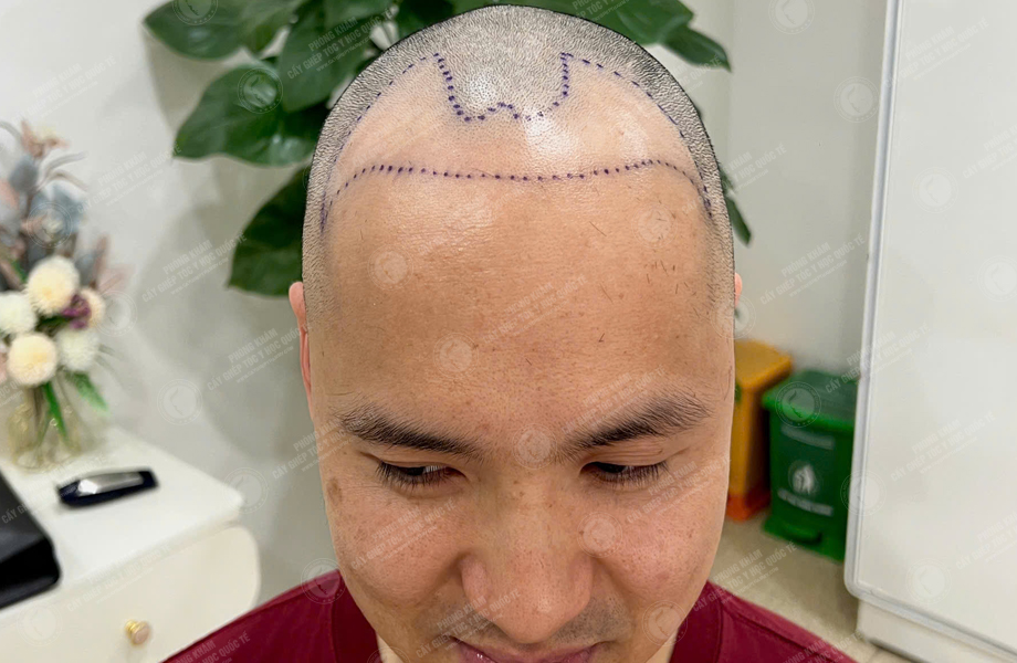 Phạm Quang Nhật - Cấy tóc đường chữ M 3