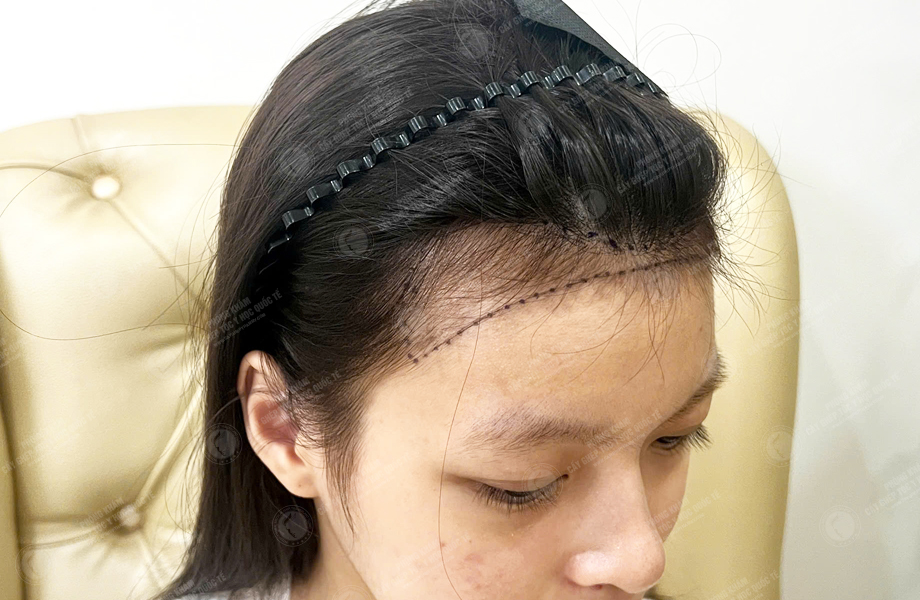 Nguyễn Thanh Tâm - Cấy tóc đường chữ M 3