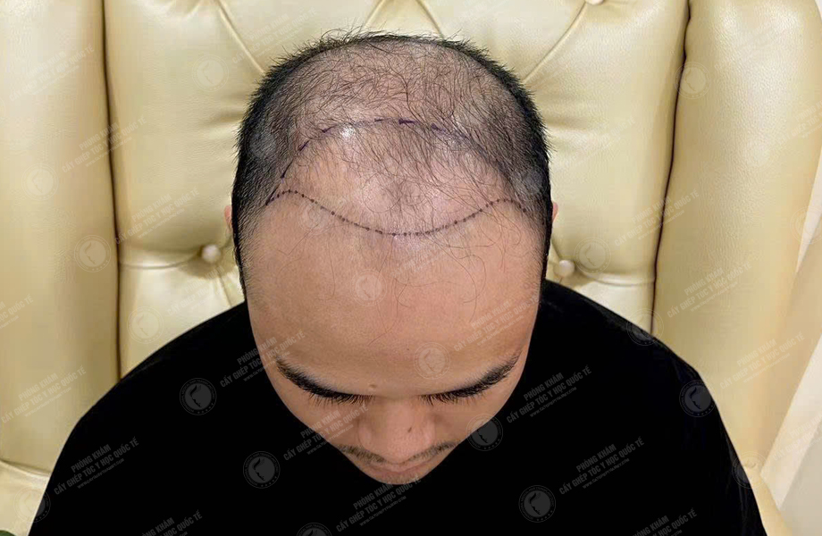Ngô Văn Tâm - Cấy tóc đường chữ M 3