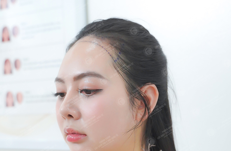 Trang Mun - Cấy tóc đường chữ M 3