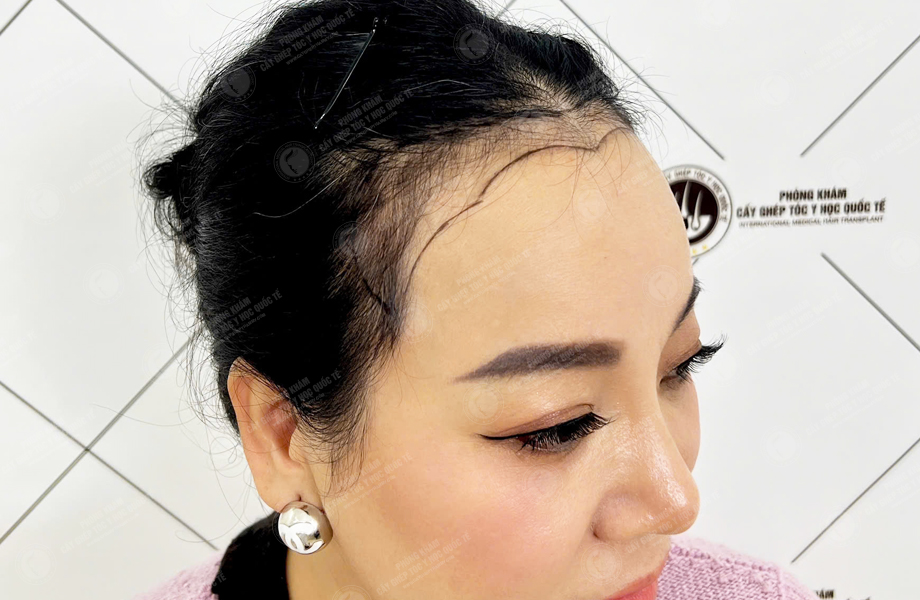 Lưu Bích Nguyệt - Cấy tóc đường chữ M 3