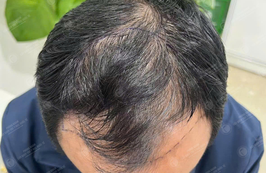 Trần Trung Anh - Cấy tóc đường chữ M 3
