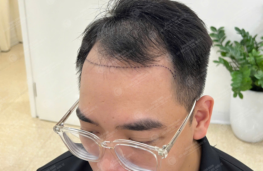 Trần Văn Nam - Cấy tóc đường chữ M 3