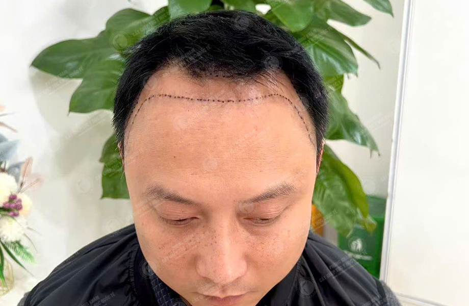Trần Xuân Đông - Cấy tóc đường chữ M 3