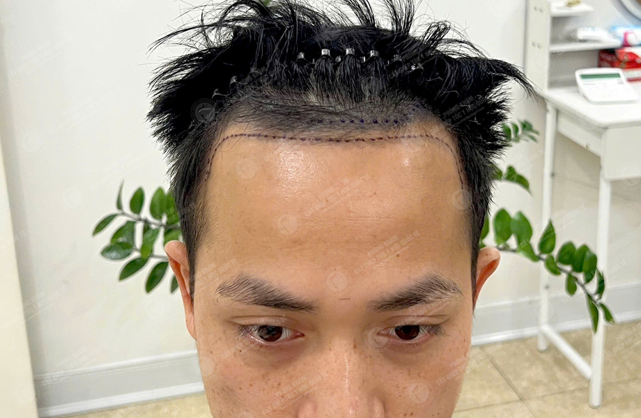 Nguyễn Huy Hùng - Cấy tóc đường chữ M 3