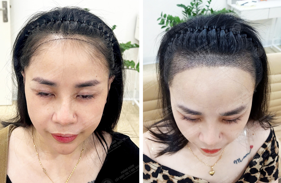  Lê Thị Hạnh - Cấy tóc đường chữ M 1