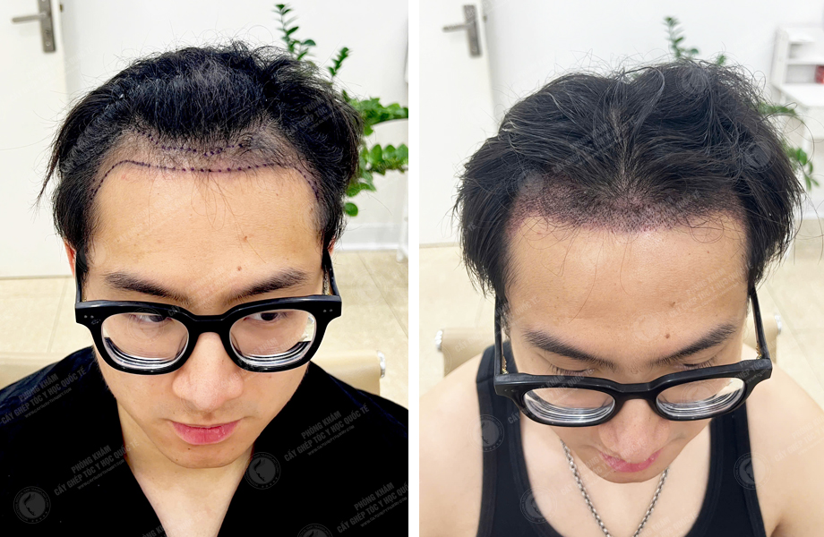  Hoàng Văn Tài - Cấy tóc tự thân 1