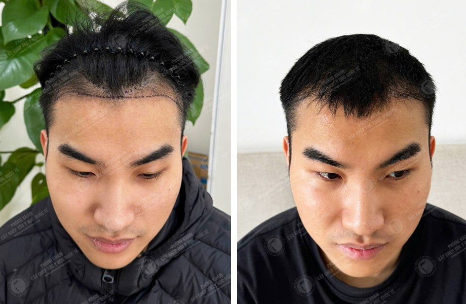  Nguyễn Đức Hùng - Cấy tóc đường chữ M 1