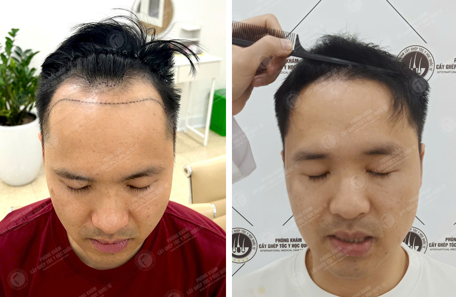  Phạm Quang Nhật - Cấy tóc đường chữ M 1