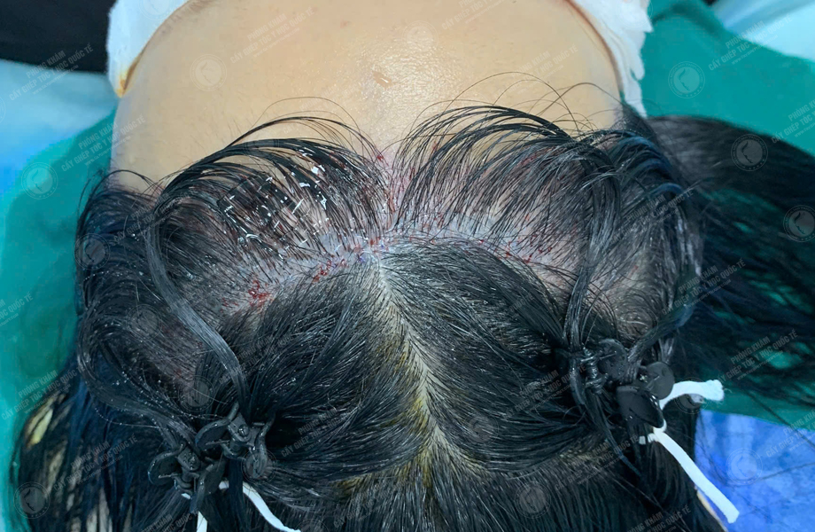 Lê Ngọc Hân - Cấy tóc đường chữ M 4