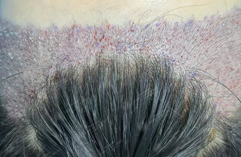 Lê Hồng Nhung - Cấy tóc đường chữ M 4