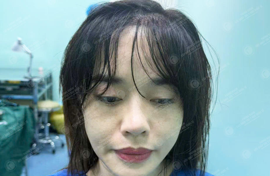 Phạm Thị Thu Trang - Cấy tóc đường chữ M 4