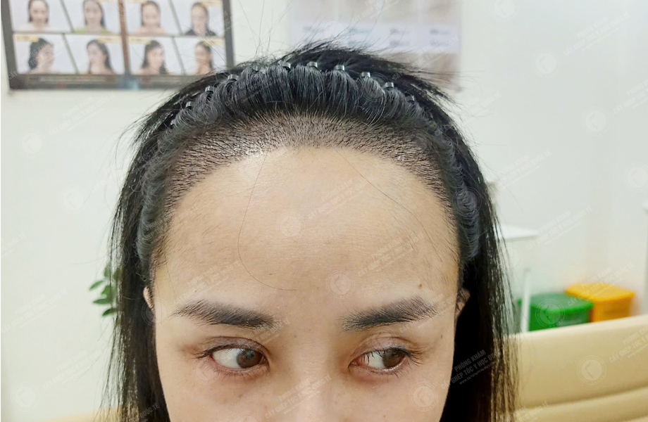 Lê Thị Hạnh - Cấy tóc đường chữ M 4
