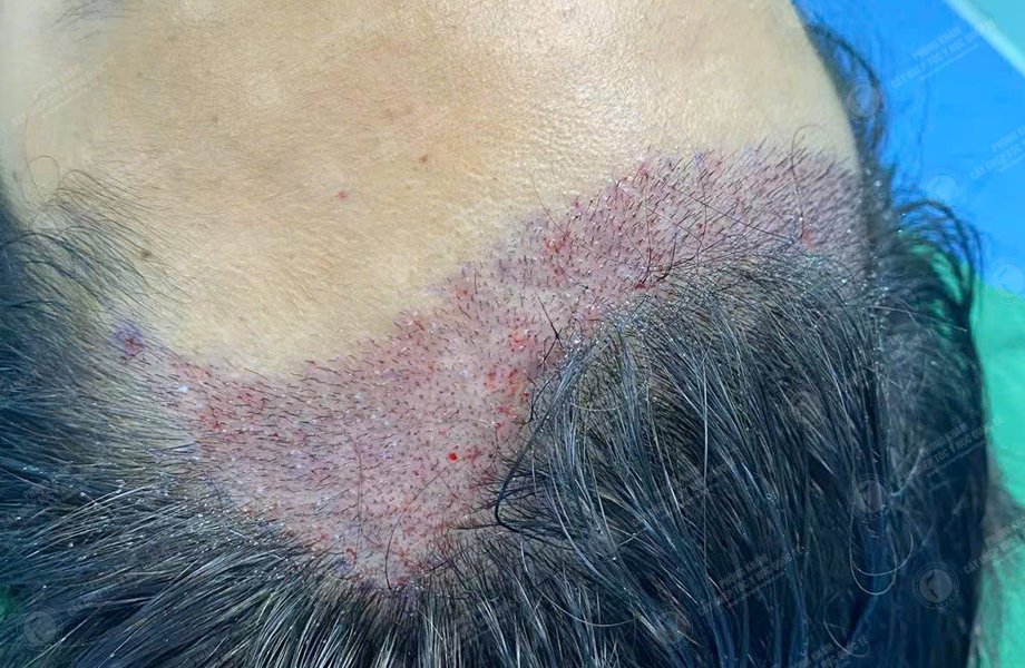 Hoàng Văn Tài - Cấy tóc đường chữ M 4