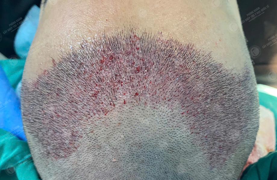 Nguyễn Đức Hùng - Cấy tóc đường chữ M 4