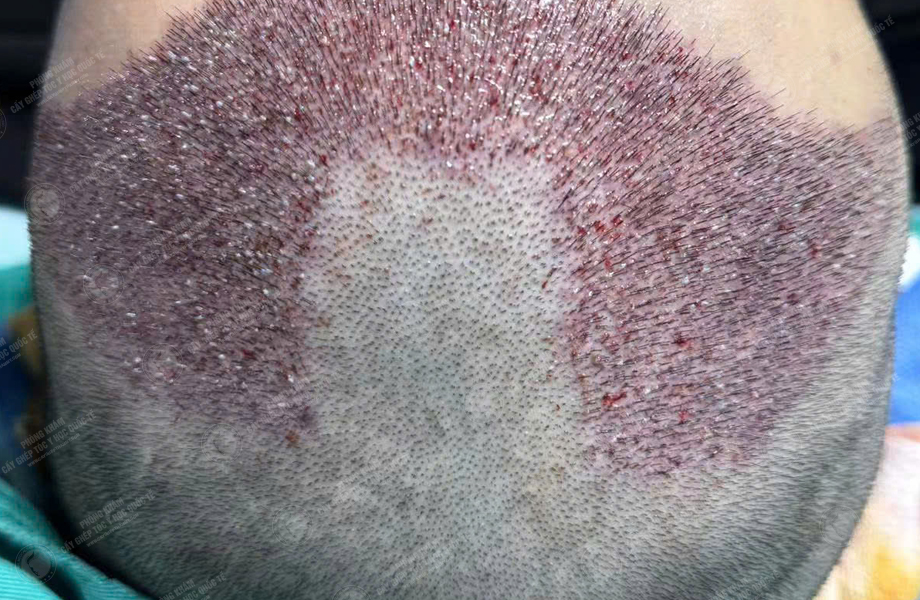 Phạm Quang Nhật - Cấy tóc đường chữ M 4