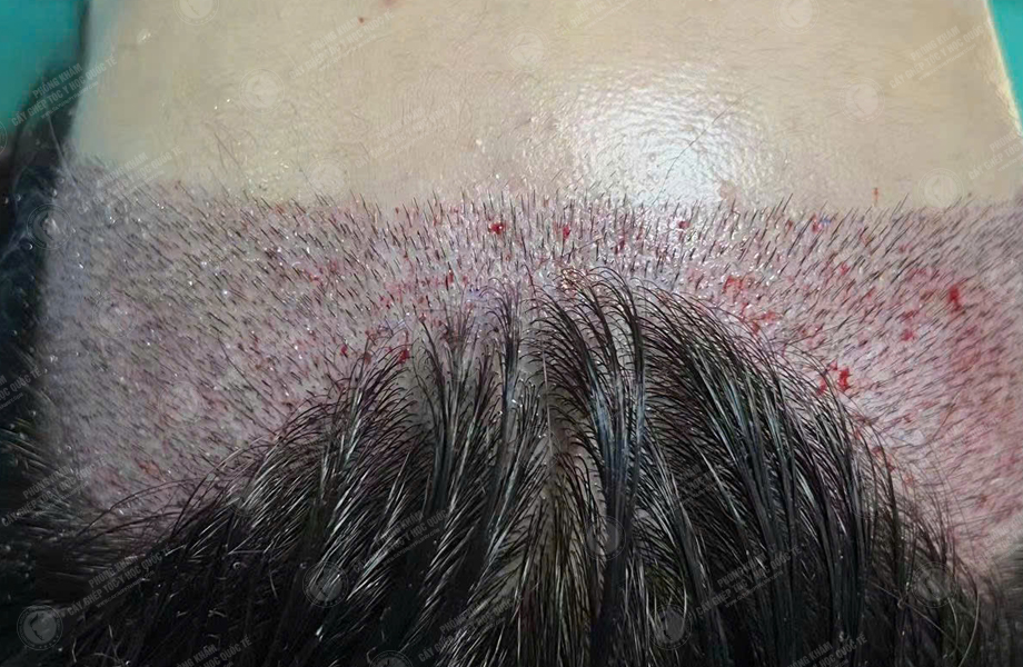 Nguyễn Thanh Tâm - Cấy tóc đường chữ M 4