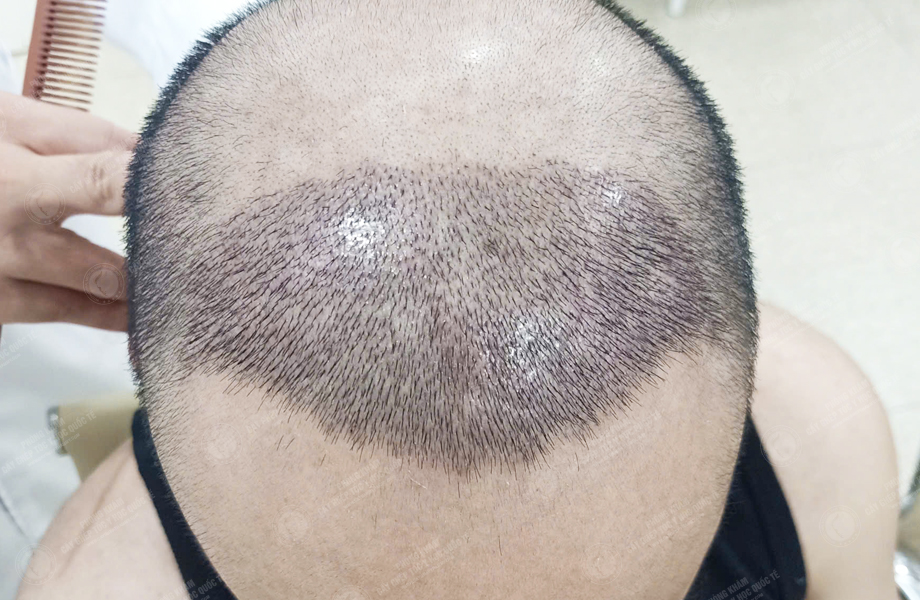 Ngô Văn Tâm - Cấy tóc đường chữ M 4