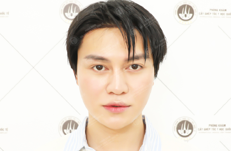 Cường Jin - Cấy tóc đường chữ M 4