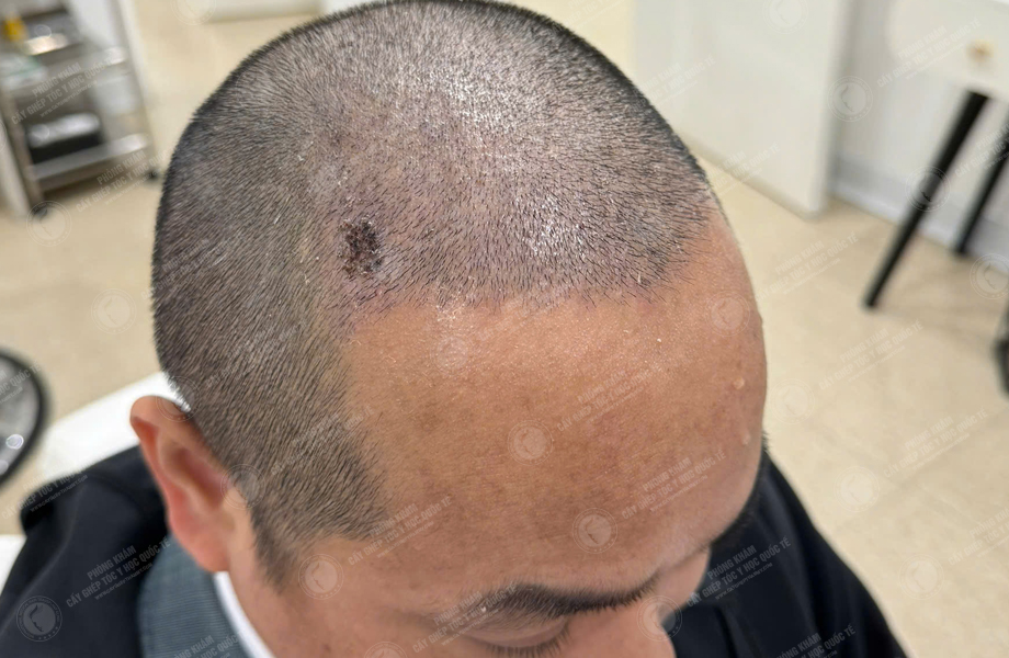 Trần Trung Anh - Cấy tóc đường chữ M 4