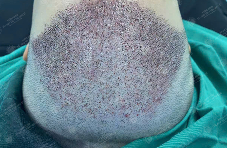 Trần Văn Nam - Cấy tóc đường chữ M 4