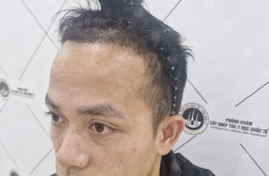 Nguyễn Huy Hùng - Cấy tóc đường chữ M 4