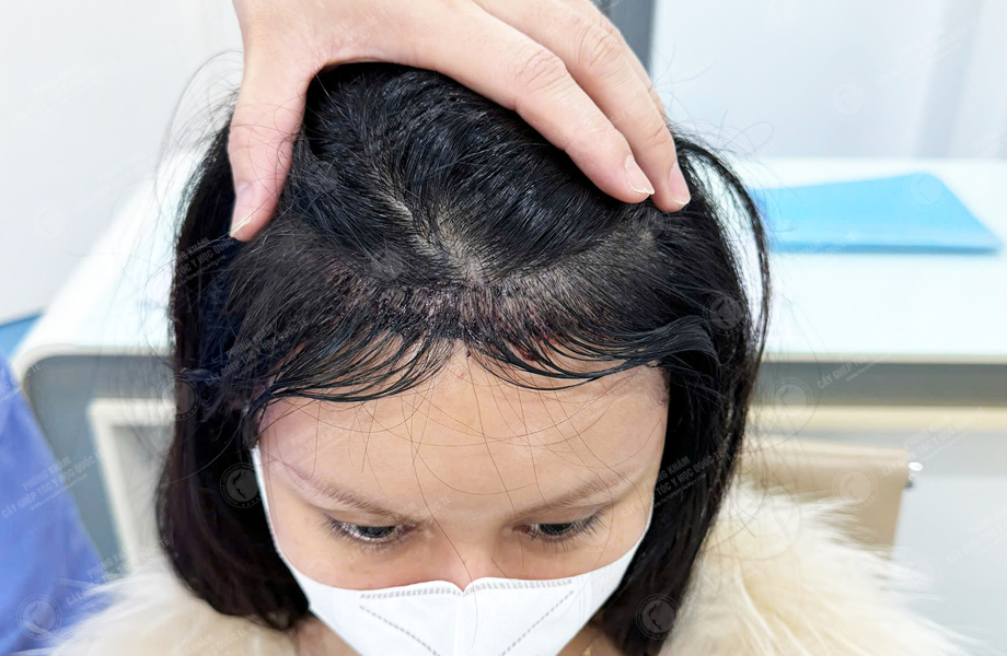 Lê Ngọc Hân - Cấy tóc đường chữ M 5