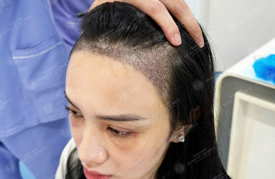 Lê Hồng Nhung - Cấy tóc đường chữ M 5