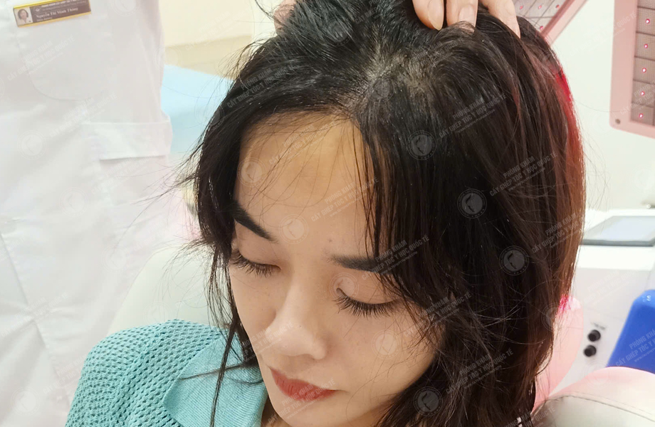 Phạm Thị Thu Trang - Cấy tóc đường chữ M 5