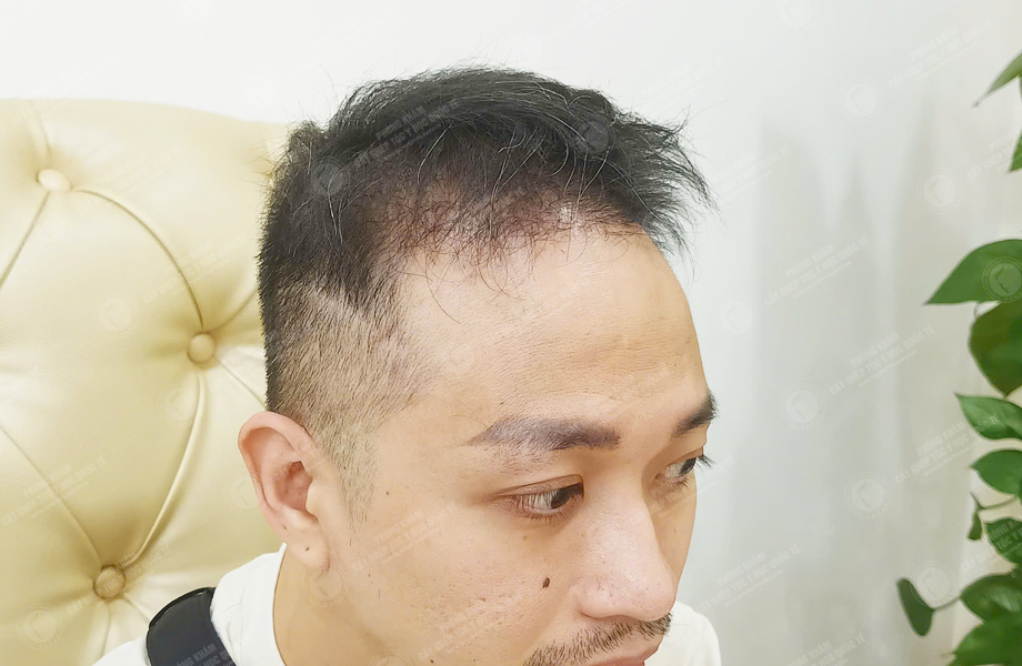 Lý Văn Thế - Cấy tóc đường chữ M 5