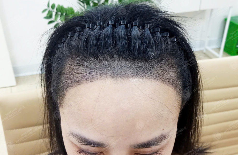 Lê Thị Hạnh - Cấy tóc đường chữ M 5