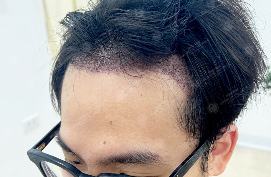 Hoàng Văn Tài - Cấy tóc đường chữ M 5