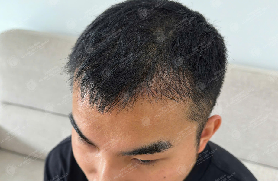 Nguyễn Đức Hùng - Cấy tóc đường chữ M 5