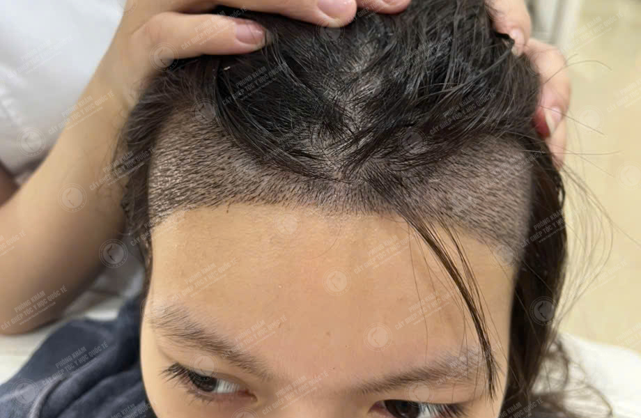 Nguyễn Thanh Tâm - Cấy tóc đường chữ M 5