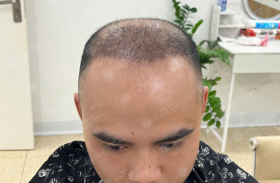 Ngô Văn Tâm - Cấy tóc đường chữ M 5