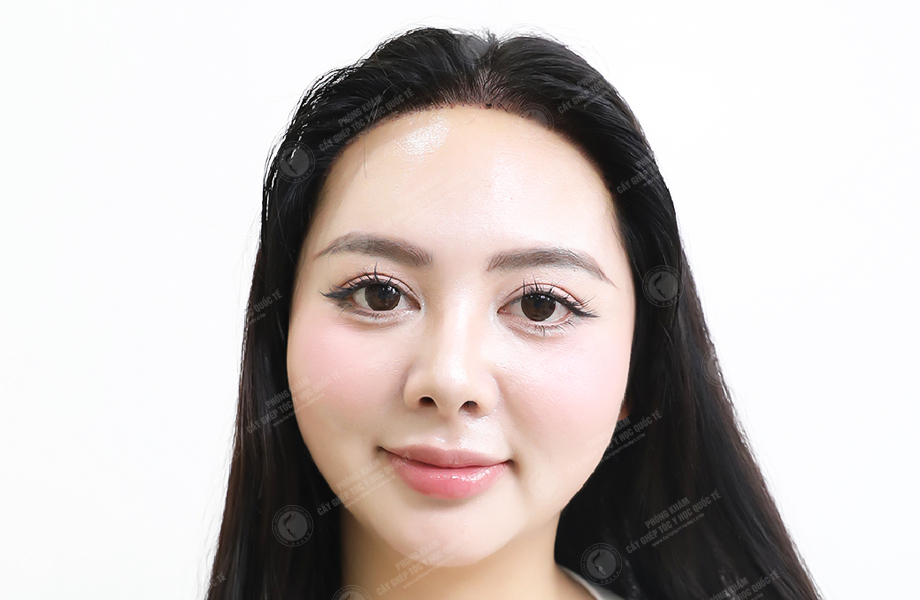 Trang Mun - Cấy tóc đường chữ M 5