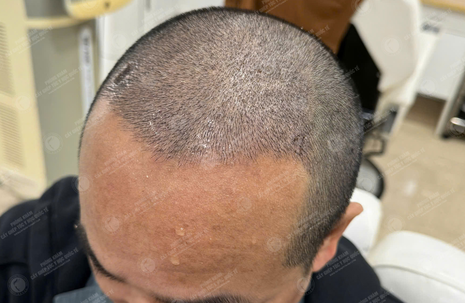 Trần Trung Anh - Cấy tóc đường chữ M 5