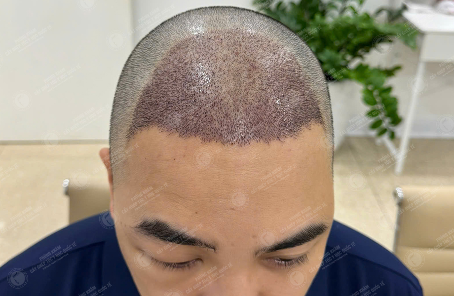 Trần Văn Nam - Cấy tóc đường chữ M 5