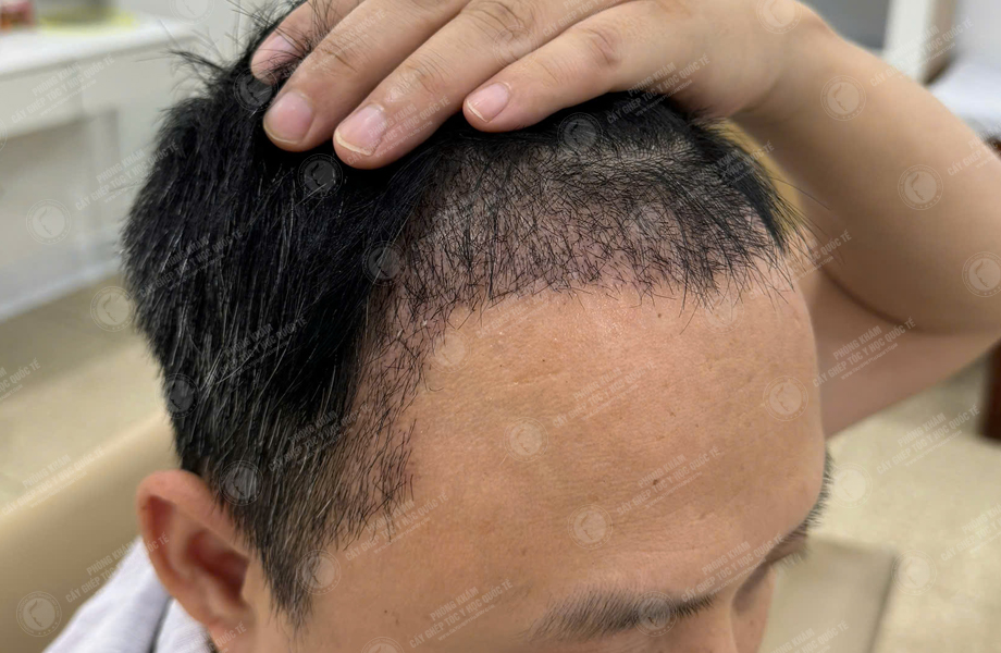Trần Xuân Đông - Cấy tóc đường chữ M 5