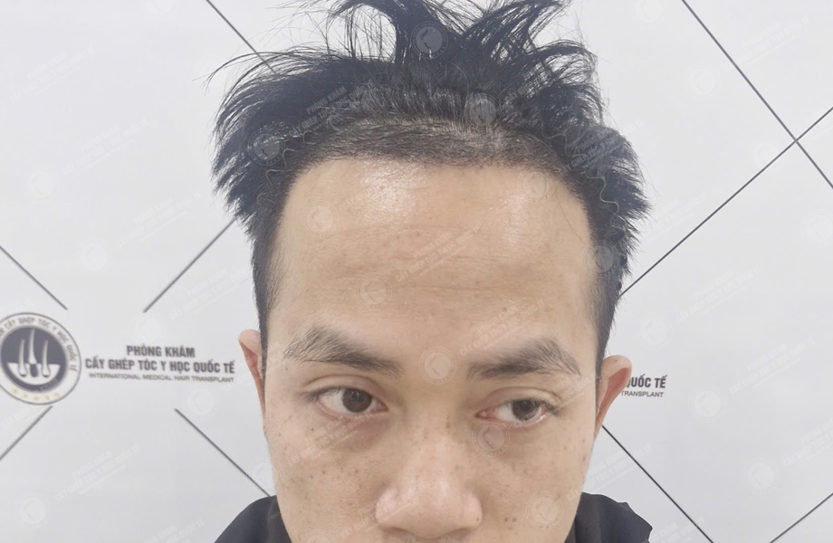 Nguyễn Huy Hùng - Cấy tóc đường chữ M 5
