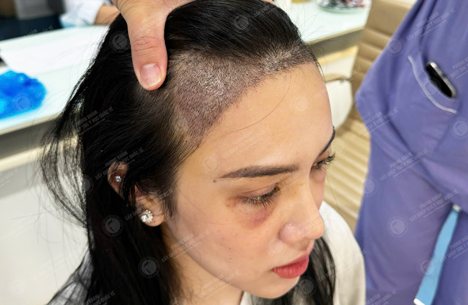 Lê Hồng Nhung - Cấy tóc đường chữ M 6